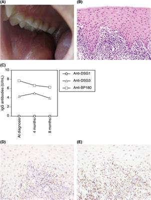 Oral lichen planus with low-titer autoantibodies to BP180 and desmoglein 3